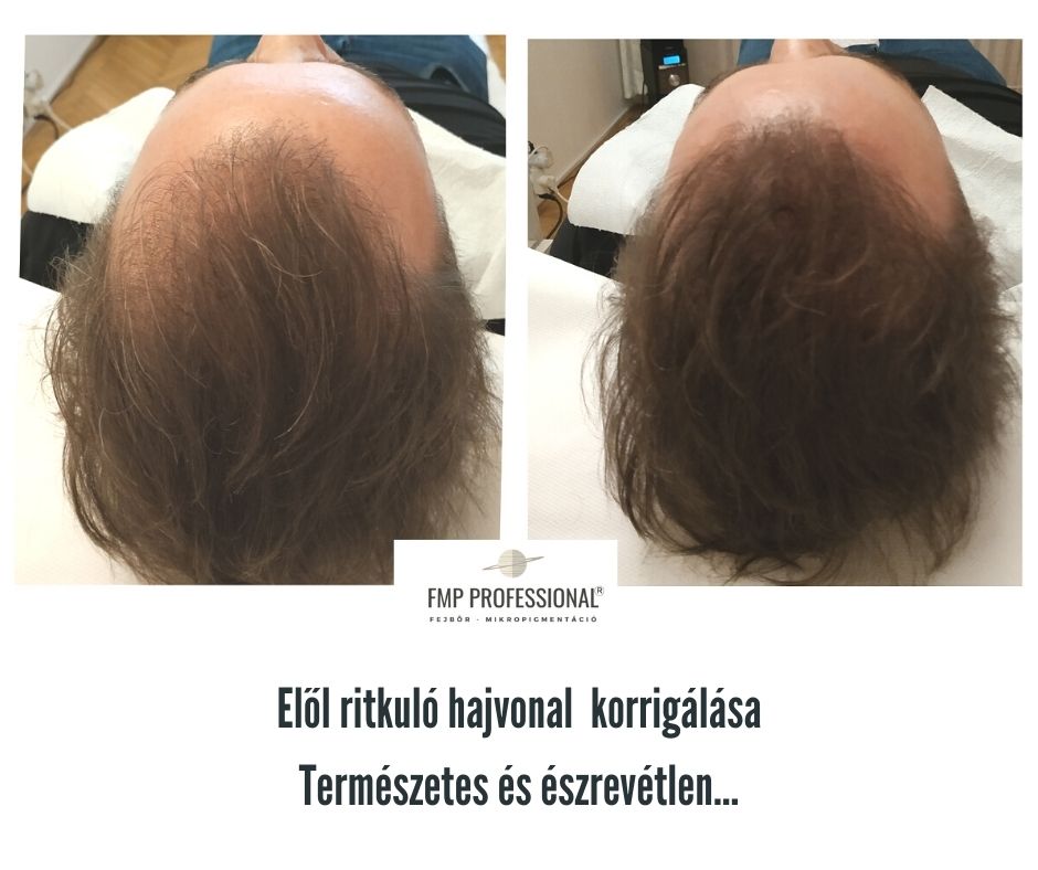 Fejbőr mikropigmentáció Budapest