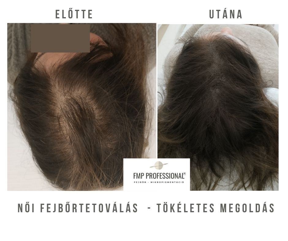 Női fejbőrpigmentáció hajhullás