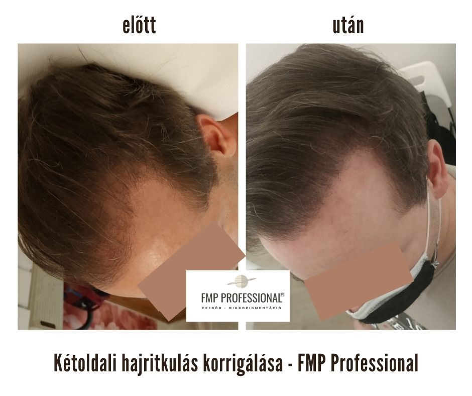 Fejbőr pigmentálás legjobb
