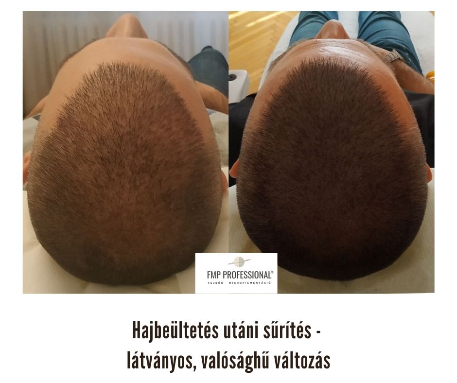Fejbőrpigmentáció tetoválás hajbeültetés után