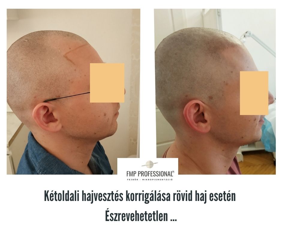 fejbőrtetoválás smp scalp micropigmentation
