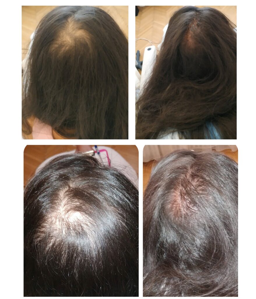 női kopaszság fejbőrtetoválás