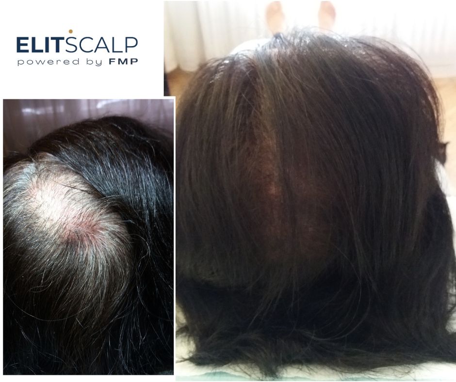 Női fejbőrtetoválás