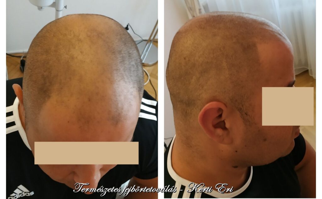 Férfi hajbeultetes után hajtetovalás