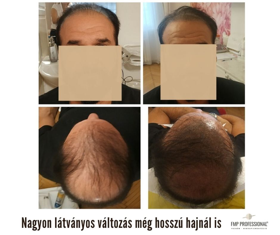 Hajtetoválás ritkuló hosszú hajra.