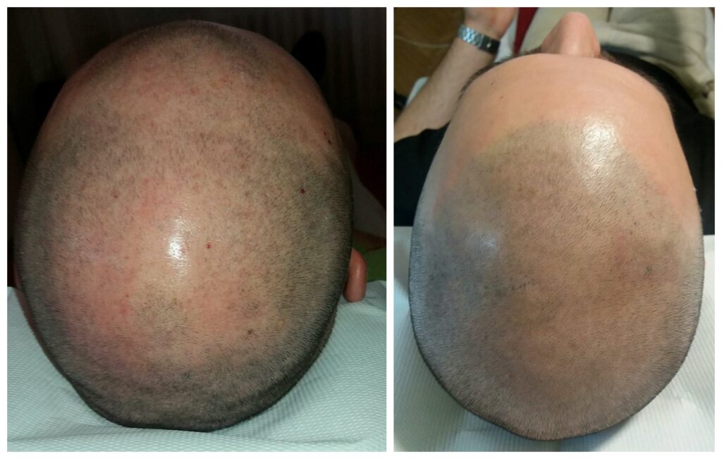 Fejbőr mikropigmentáció Kerti Eri