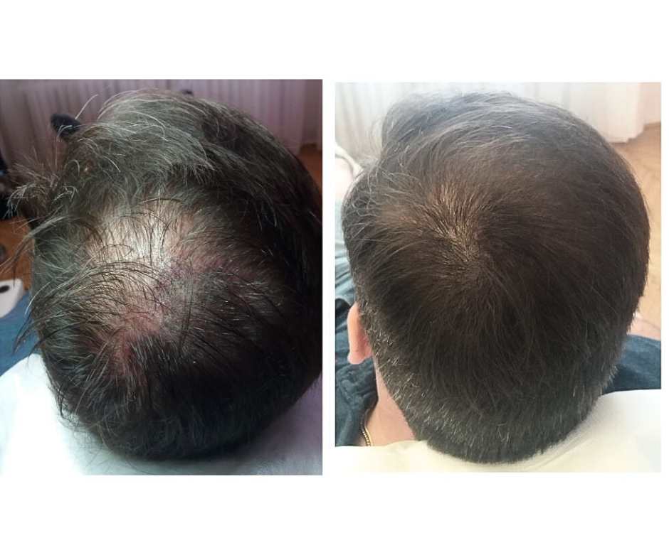 SMP árak fejbőrtetoválás ElitScalp
