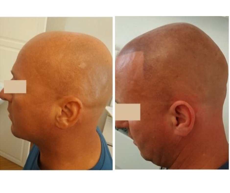 ElitScalp Fejbőr mikorpigmentáció férsi kopaszodás ellen