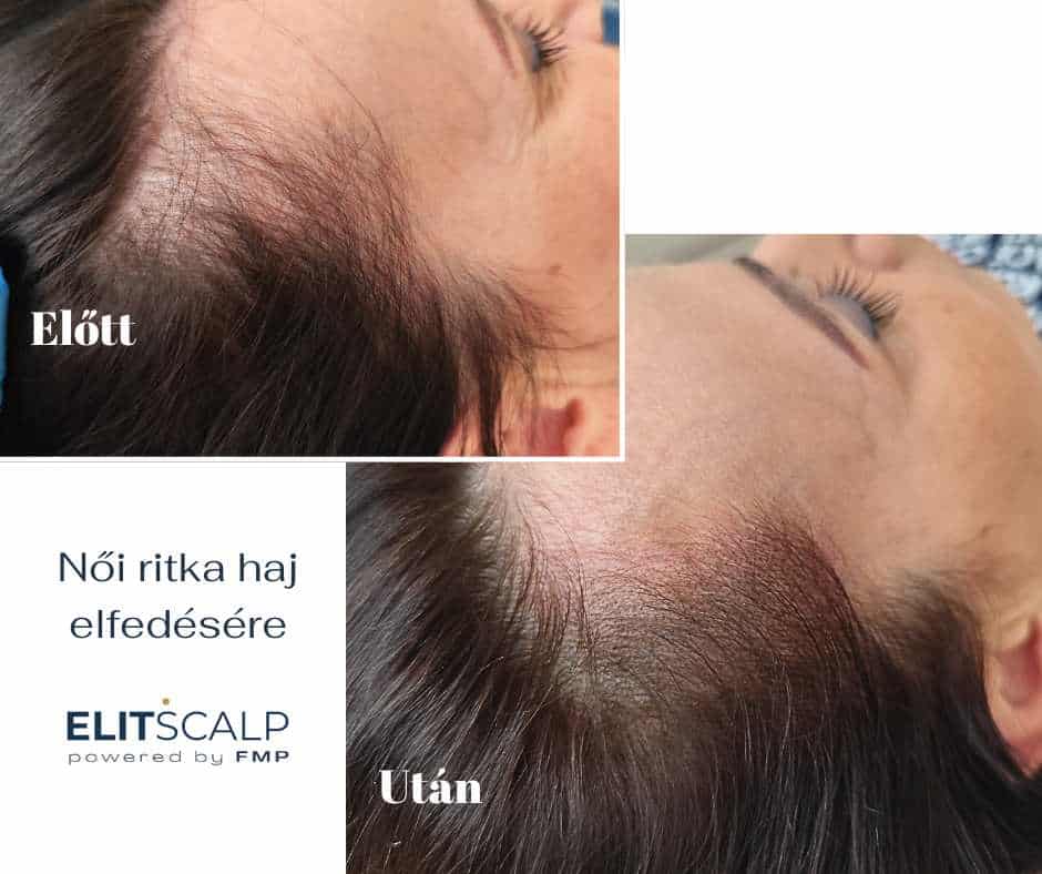 Fejbortetovalas Női hajhullás