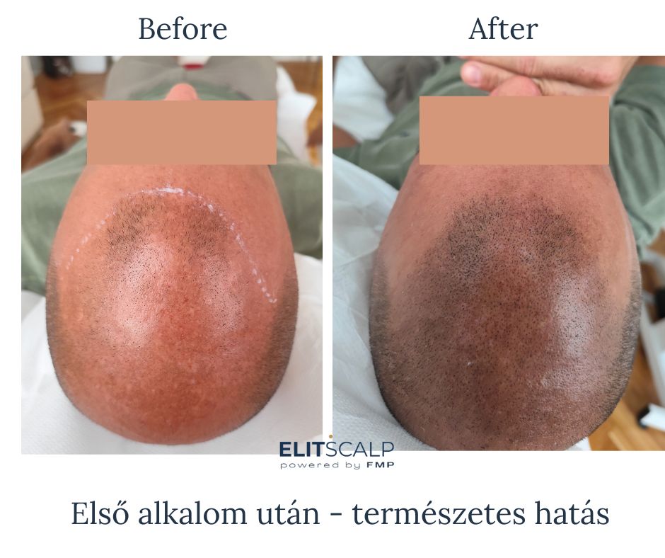 Férfi kopaszság SMP fejbőrtetoválás Budapest