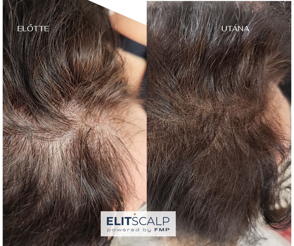 Női kopaszság ellen