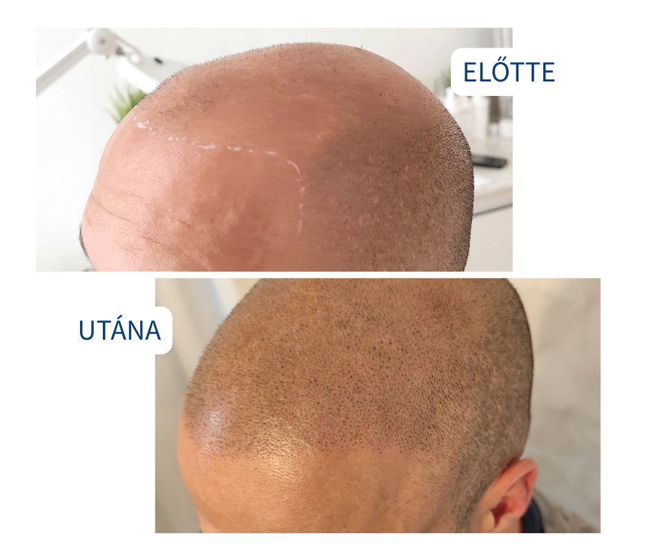 Fejbortetovalas ELITSCALP férfi kopaszság ellen