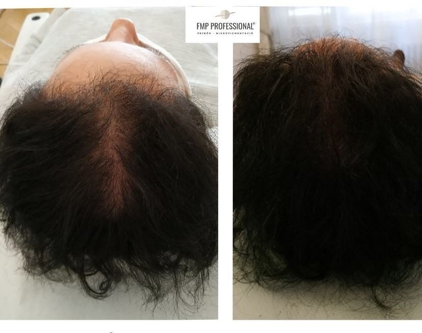 noi kopaszodas hajtetovalas ElitScalp